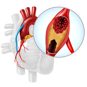 Coronary Artery Bypass Grafting 