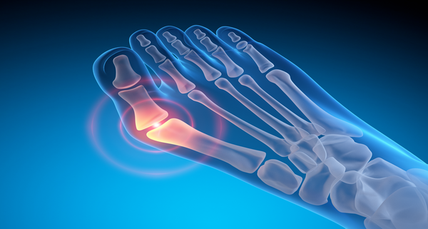 Valgus deformity of the big toe