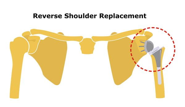 Reserve Shoulder Replacement