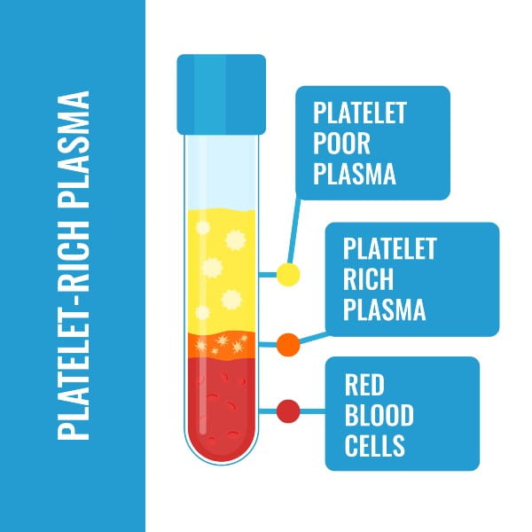 Platelet-rich plasma composition medical infographics