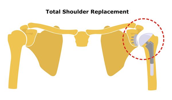 Total Shoulder Replacement