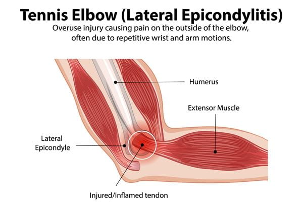 Tennis Elbow