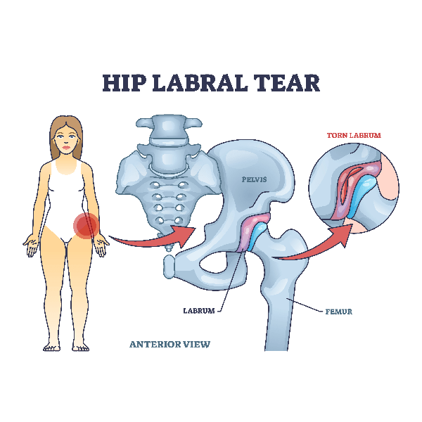 Ortho Hip Labral Blog_Hip labral tear