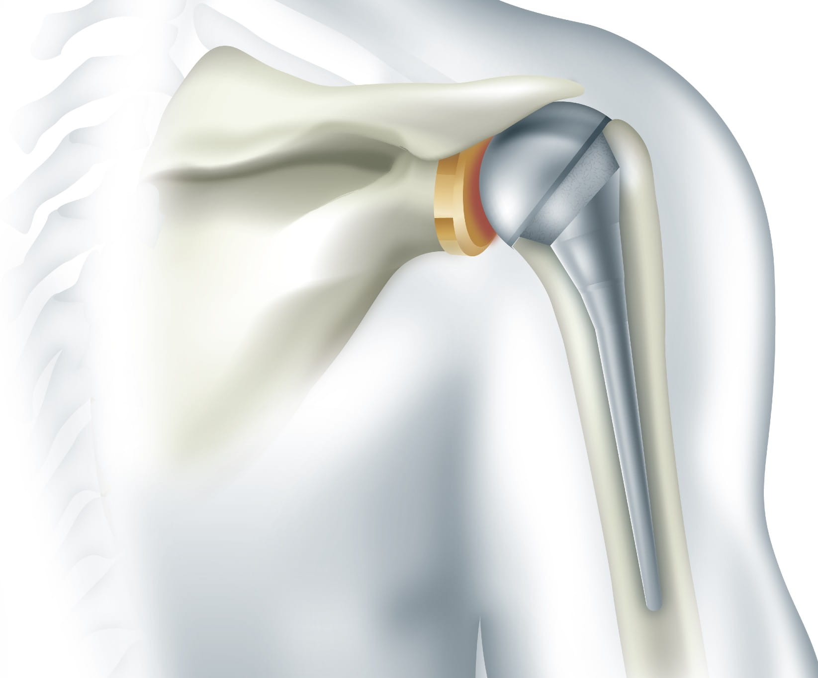 From Rotator Cuff Repair to Shoulder Replacement: Your Guide to Shoulder Surgery Rotator Cuff Blog Shoulder Replacement